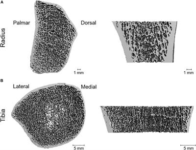 Microarchitecture of Heterotopic Ossification in Fibrodysplasia Ossificans Progressiva: An HR-pQCT Case Series